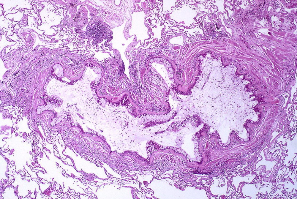 Corte histológico que demuestra obstrucción de un bronquiolo por exudado mucoso, metaplasia de células caliciformes, engrosamiento de la membrana basal epitelial e inflamación severa. 